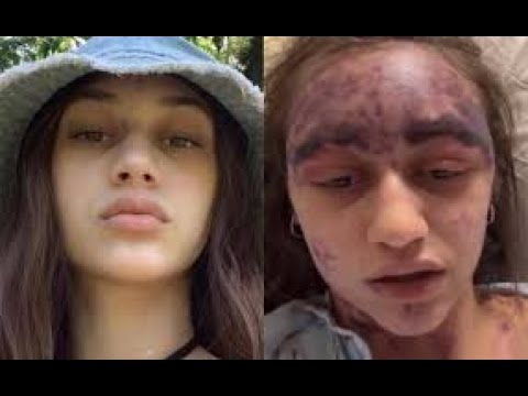 ALEXIS LORENZE STORY :The Tragic Vaccine Reaction: A Young Woman's Fight for Life
