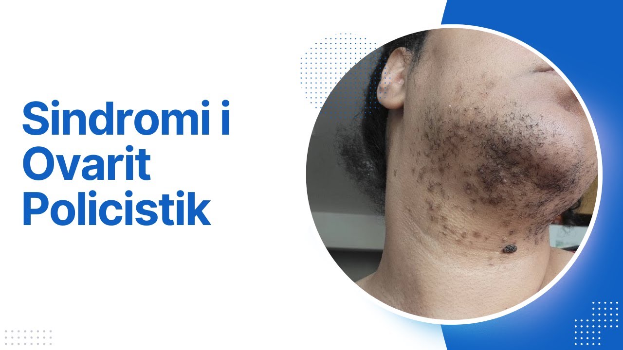 Sindromi i Ovarit Policistik